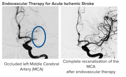 Acute Ischemic Stroke Acute Ischemic Stroke