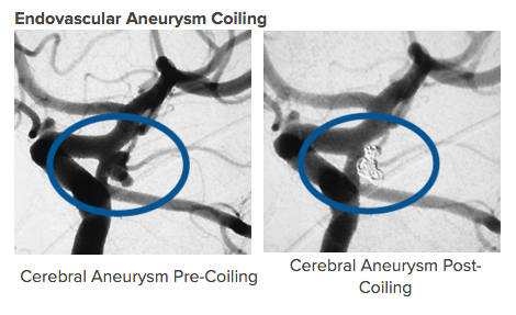 Aneurysms Coiling