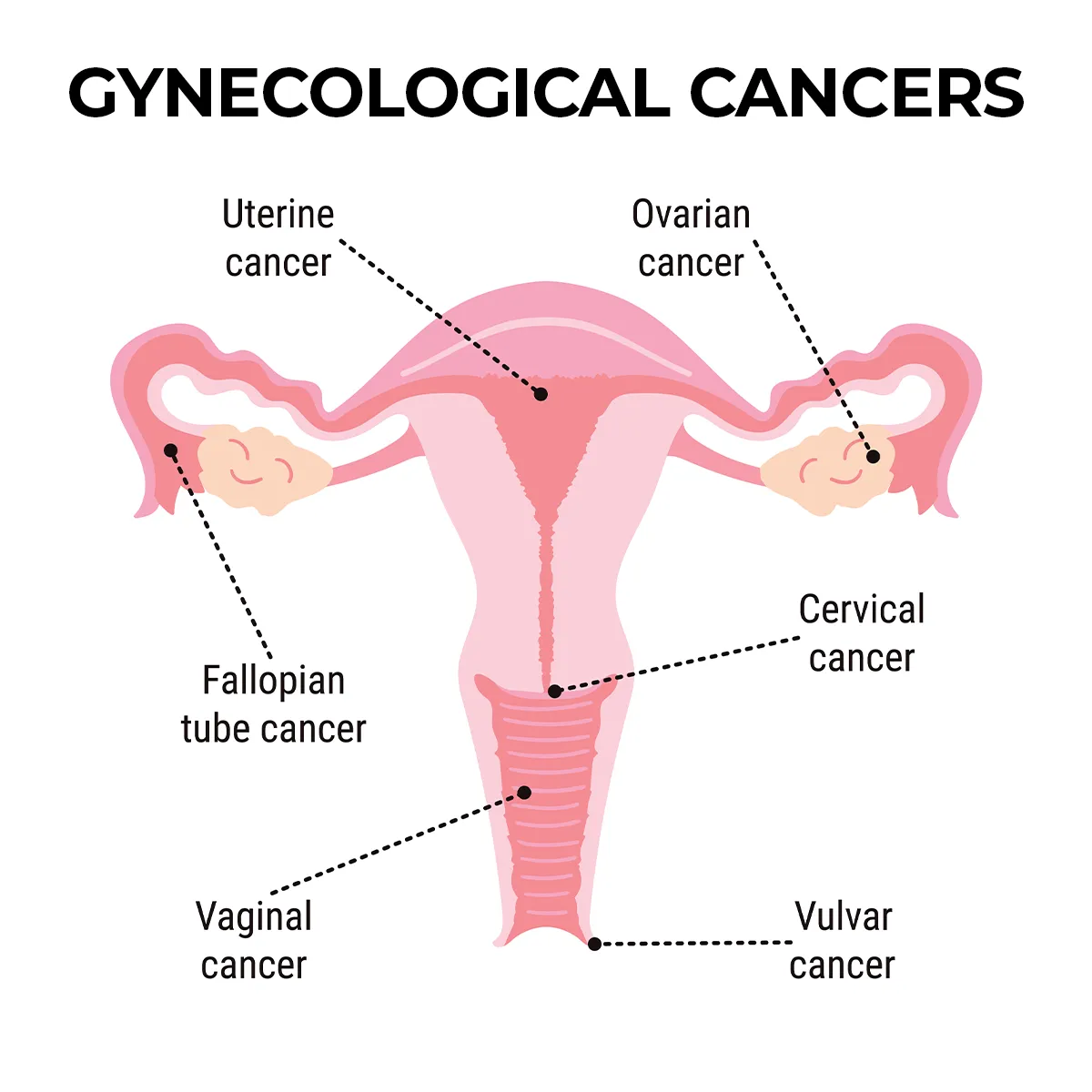 The image shows the location of each of the following types of gynecologic cancers; uterine cancer, ovarian cancer, fallopian tube cancer, cervical cancer, vaginal cancer and vulvar cancer. 