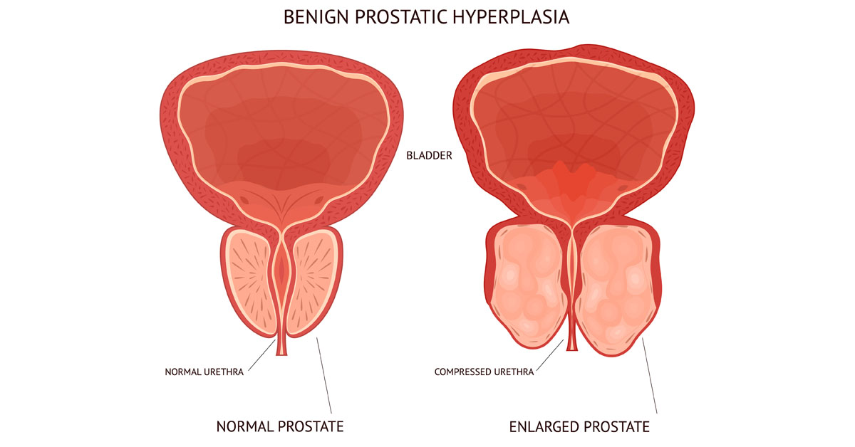 Normal vs enlarged prostate graphic