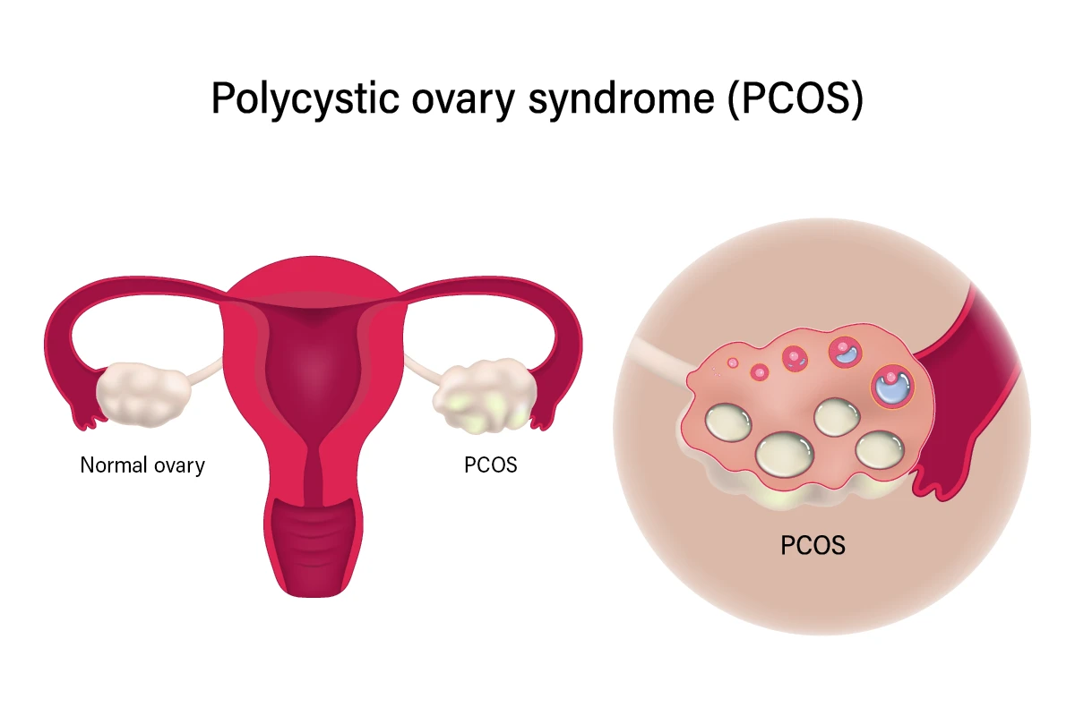 illustration of a female reproductive system showing a normal ovary on one side and an ovary with polycystic ovary syndrome (PCOS) on the other. The PCOS-affected ovary is enlarged and contains multiple fluid-filled cysts.
